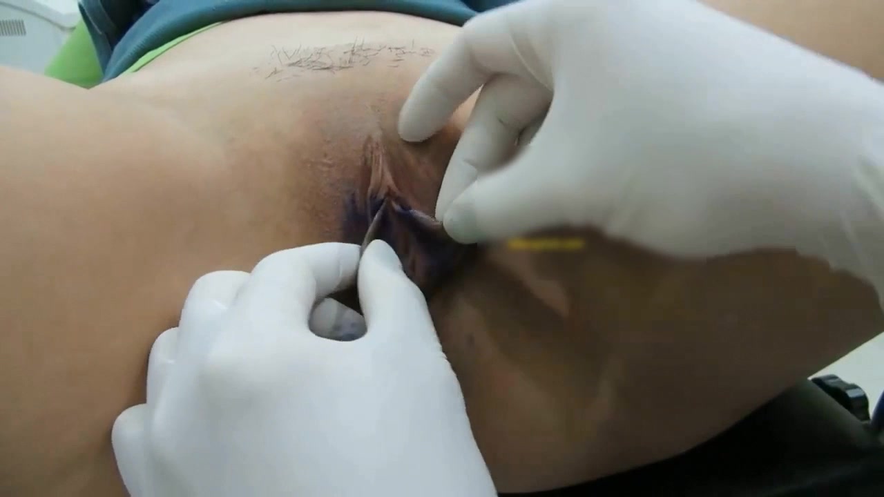 珍稀资源新加坡华裔帅哥整形医学博士内部交流视频外阴唇切除巧变馒头逼